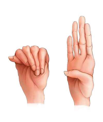 MARFAN-SYNDROME-HAND