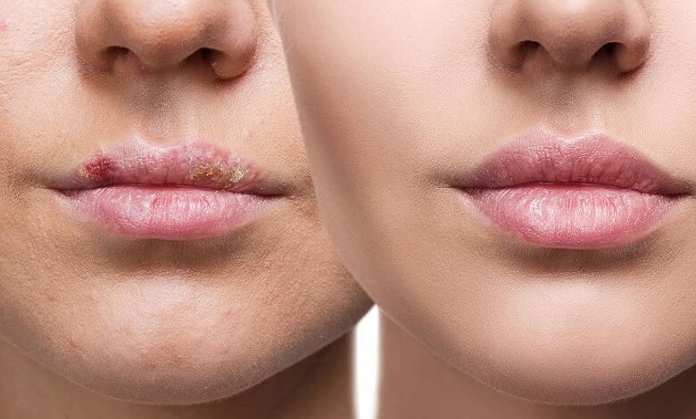 treatment-herpes-lips-min